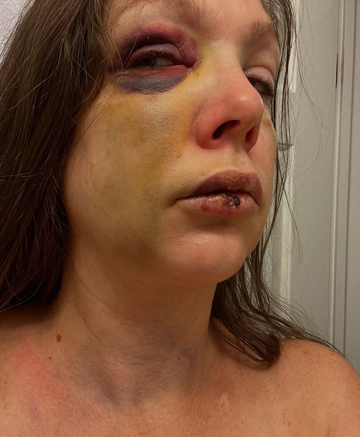 Single mom with bruised face and swollen lips after brutal beating, criticizing police chief's statement in Cincinnati incident.