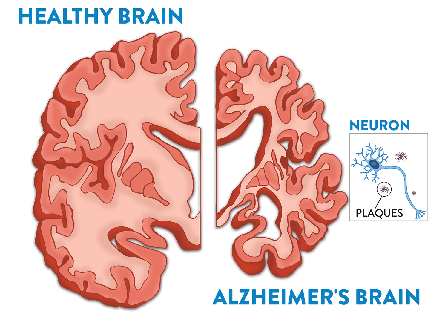 Your Brain and Alzheimer's - Fisher Center for Alzheimer's ...