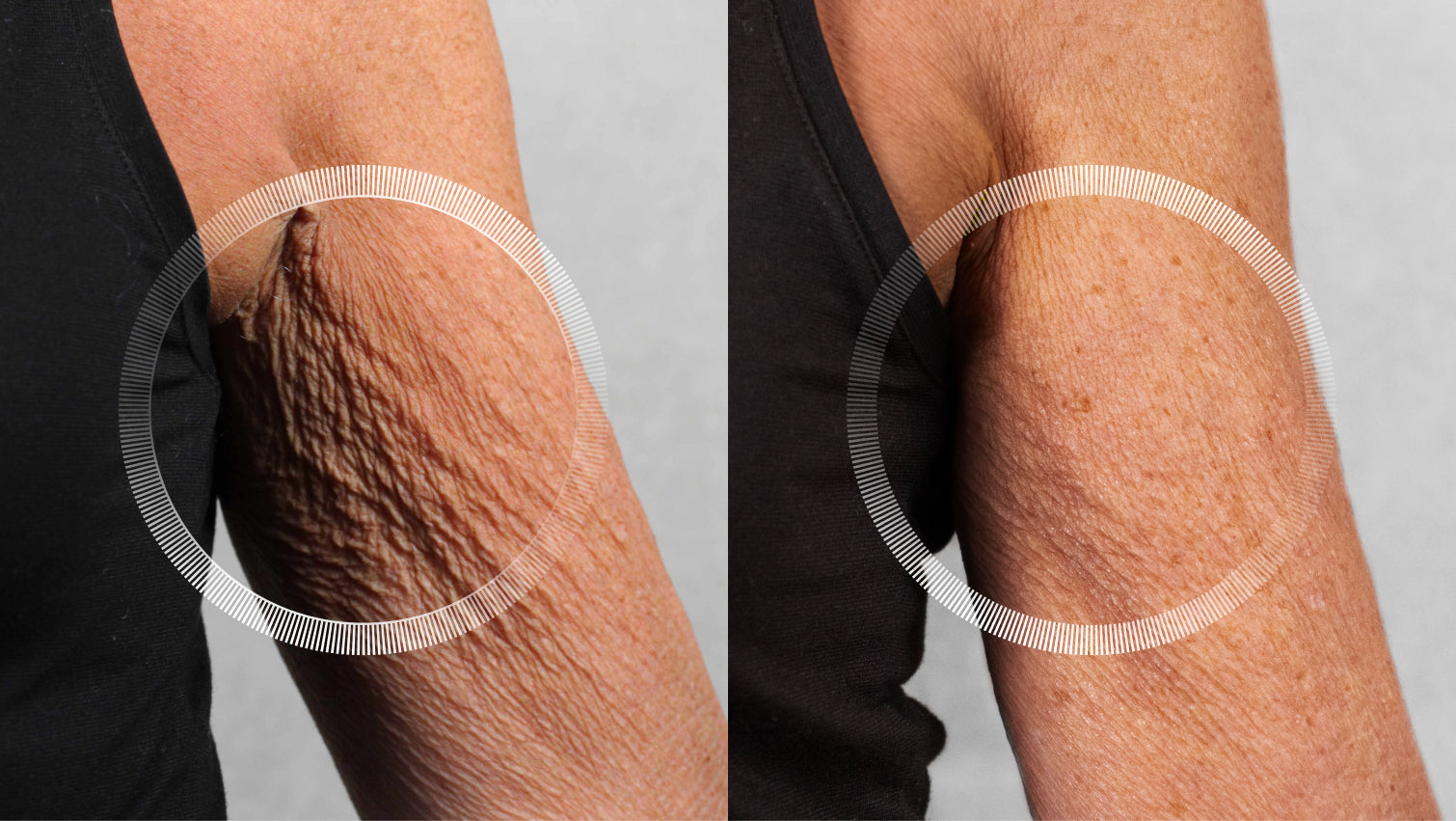 LYMA Laser Pro for Body and Under-arm Sagging Skin tightening