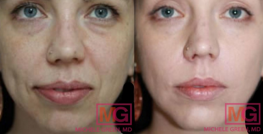 Under Eye Bag Treatment - Dr. Michele Green M.D.