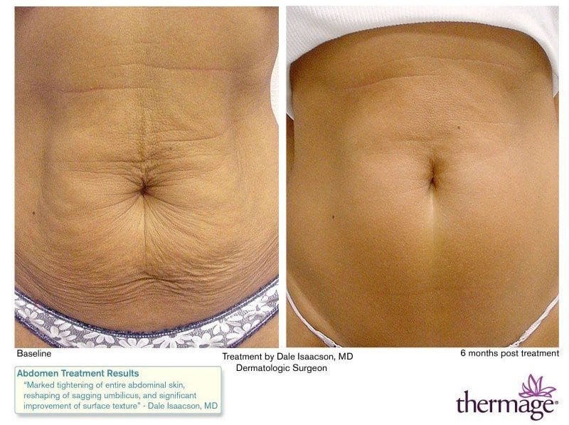 Thermage Before and After | Thermage Skin Tightening | Thermage ...